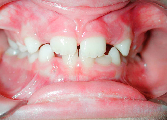 Caso 5 - Ortodontia em Crianças - antes