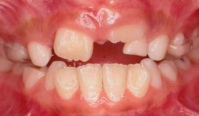 Caso 2 - Ortodontia em crianças - antes