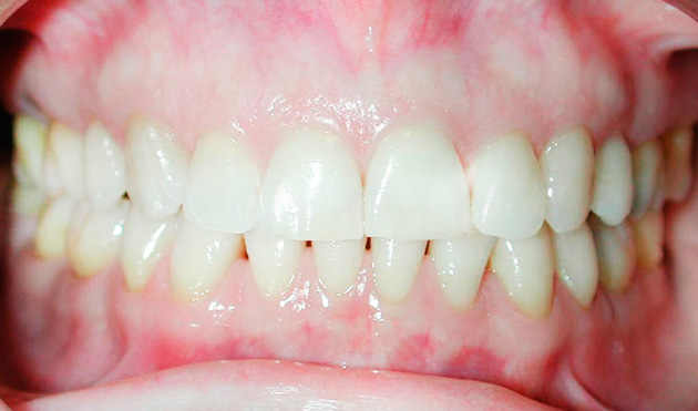 Caso 1 - Ortodontia em Adulto - depois