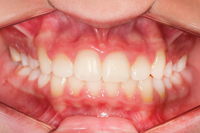 Caso 5 - Ortodontia em Crianças - depois