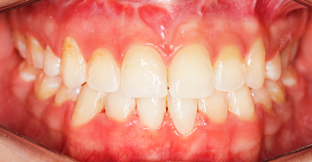 Caso 6 - Ortodontia em Adultos  - depois