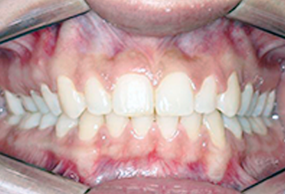 Disfunções da  atm