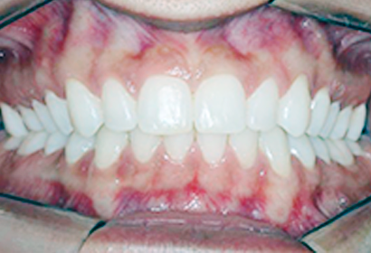 Disfunções da  atm